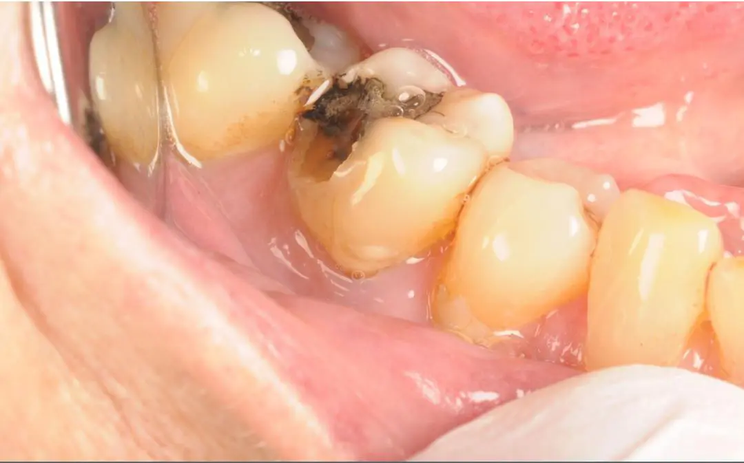 Before White Fillings