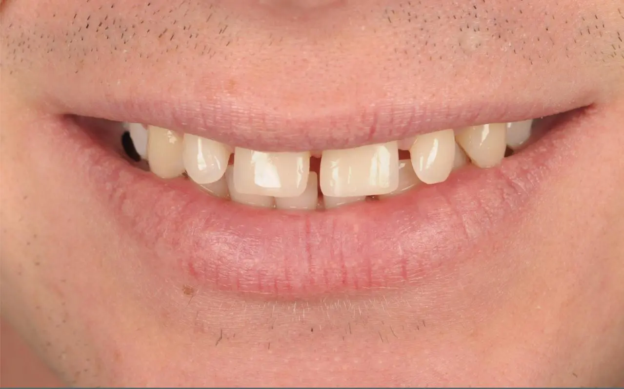 Before Gap Tooth Bonding