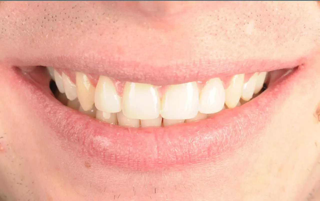 After Gap Tooth Bonding