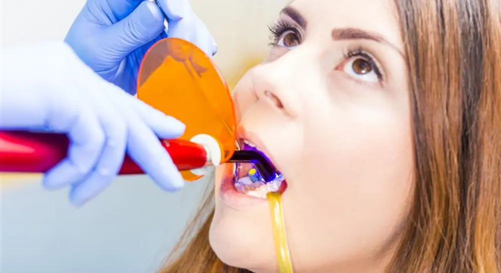 Composite Bonding Explained: Types, Benefits, Process, and Aftercare