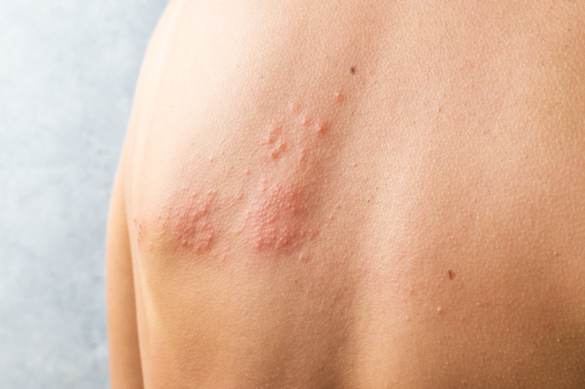 What Does Herpes Look Like? Signs, Symptoms & Appearance on Different Body Parts
