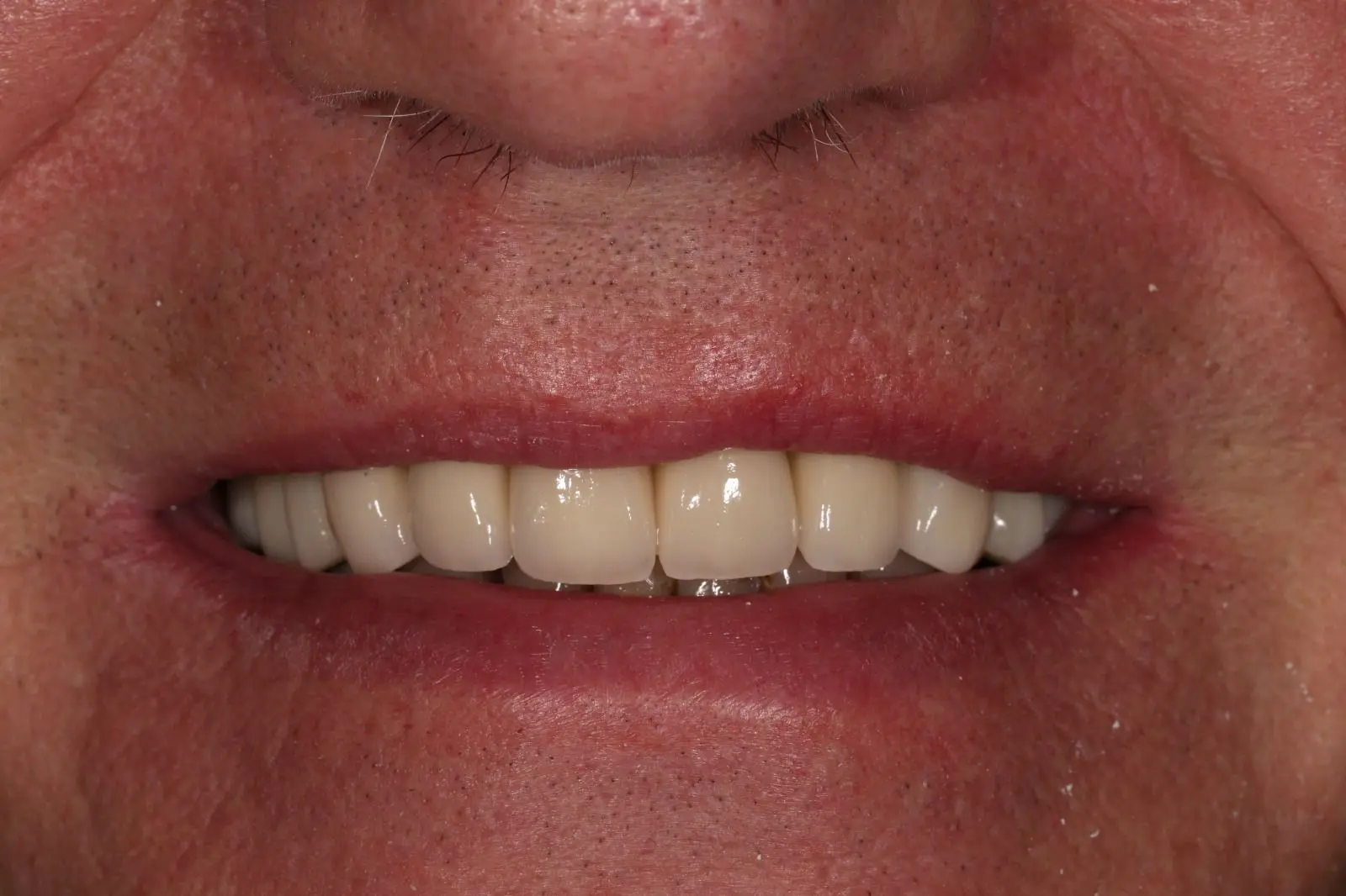 After All-on-4 treatment - case 1