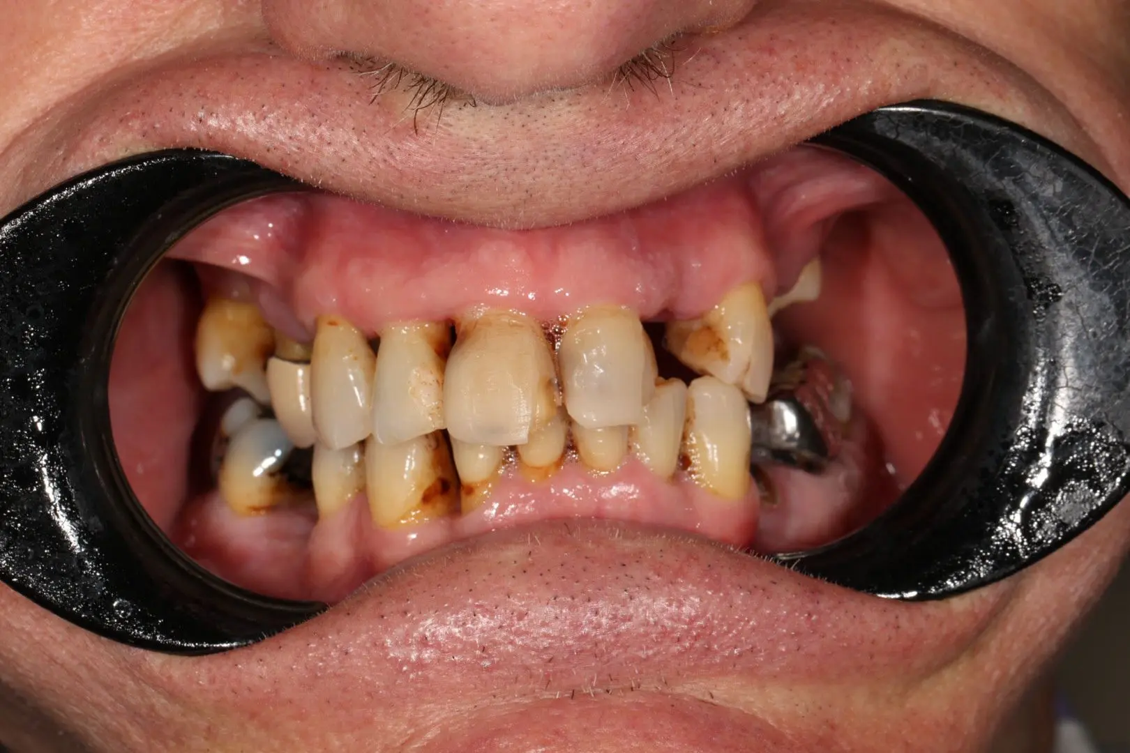 Before full mouth rehabilitation - case 2