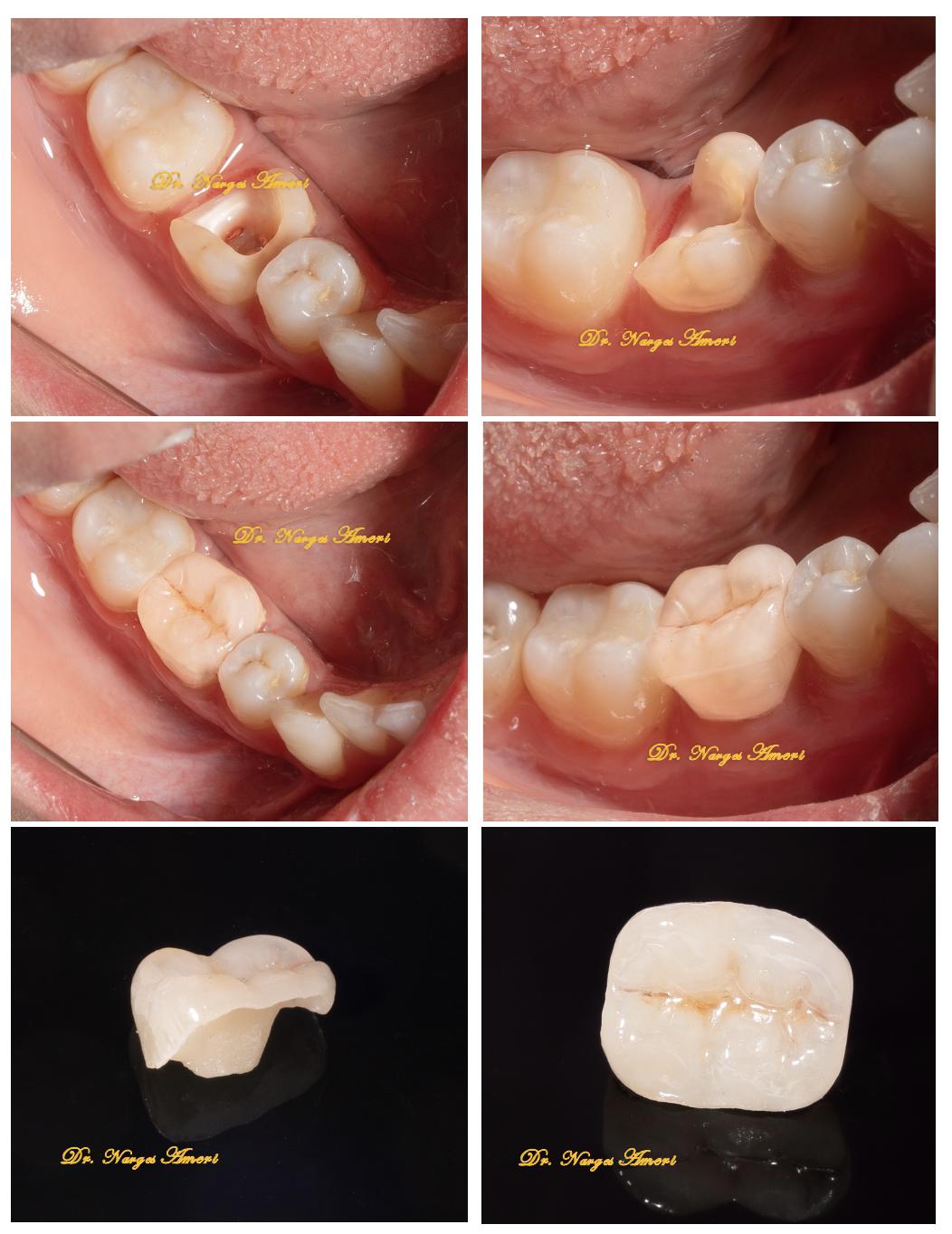 Endocrown Restoration - Before and After by Dr. Narges Ameri