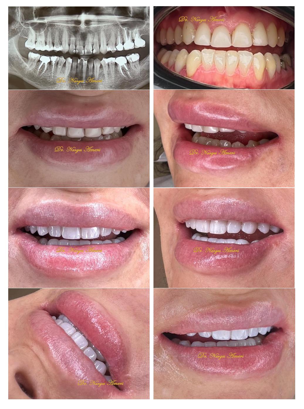 Composite Veneers - Before and After by Dr. Narges Ameri