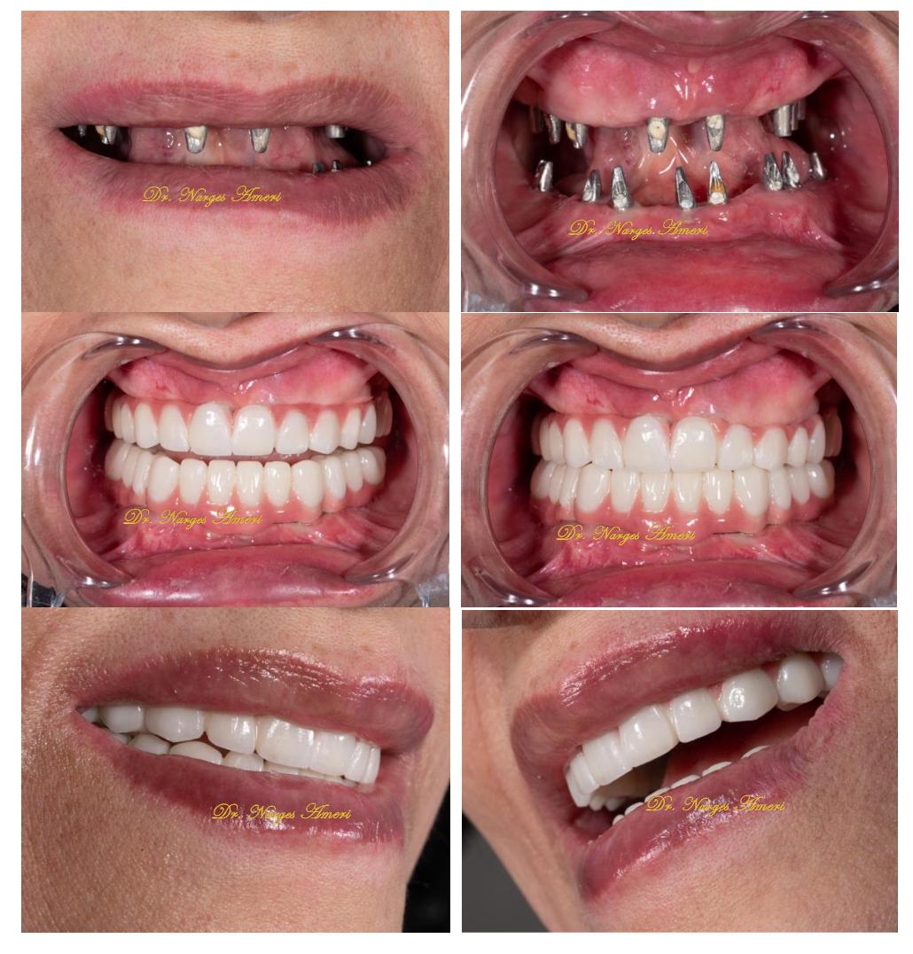 Full Mouth Rehabilitation - Before and After by Dr. Narges Ameri