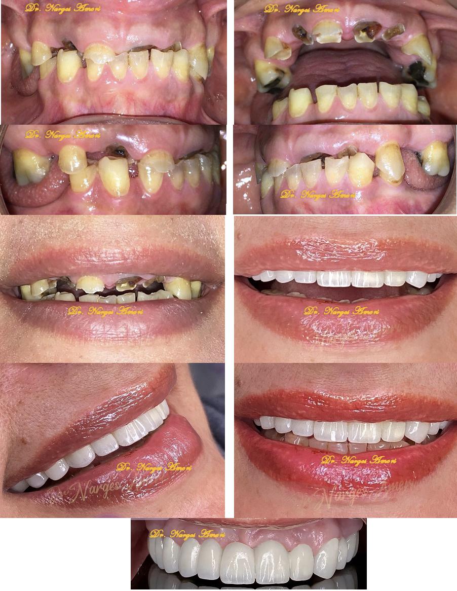 Full-Mouth Rehabilitation - Before and After by Dr. Narges Ameri