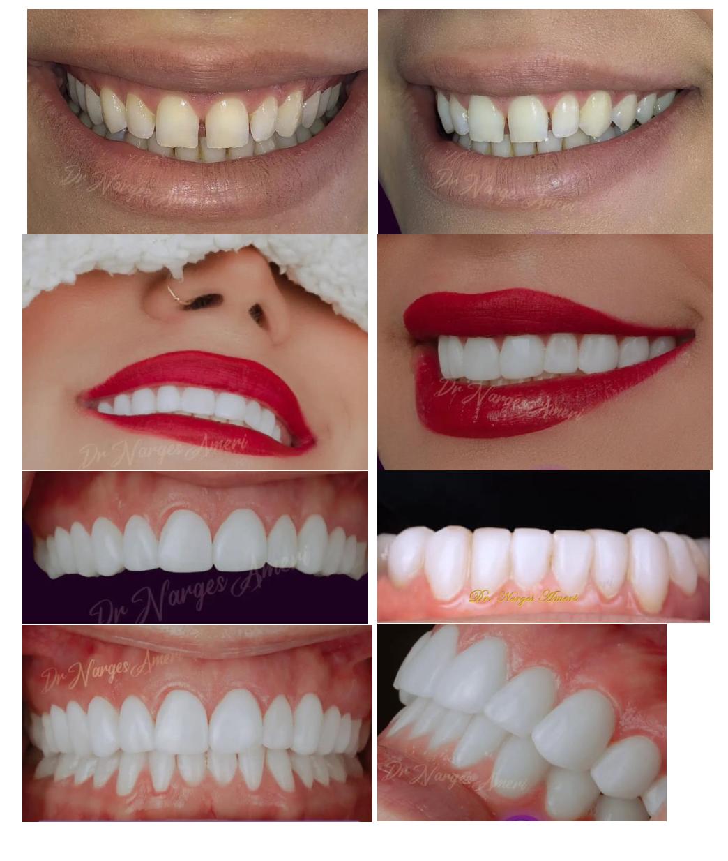 Composite Veneers - Before and After by Dr. Narges Ameri