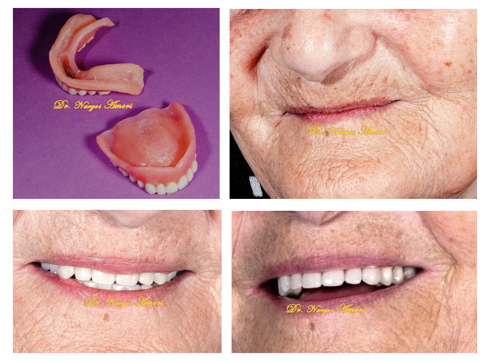 Implant-Supported Overdenture - Before and After by Dr. Narges Ameri