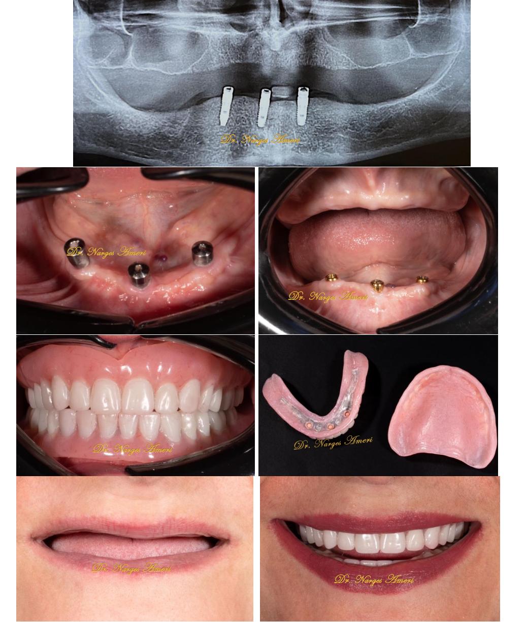 Implant-Supported Overdenture - Before and After by Dr. Narges Ameri