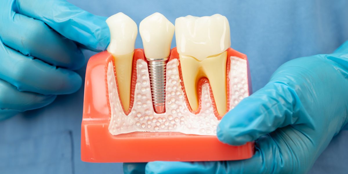 Missing Teeth: What Happens If You Don't Replace Them? | St Paul's ...