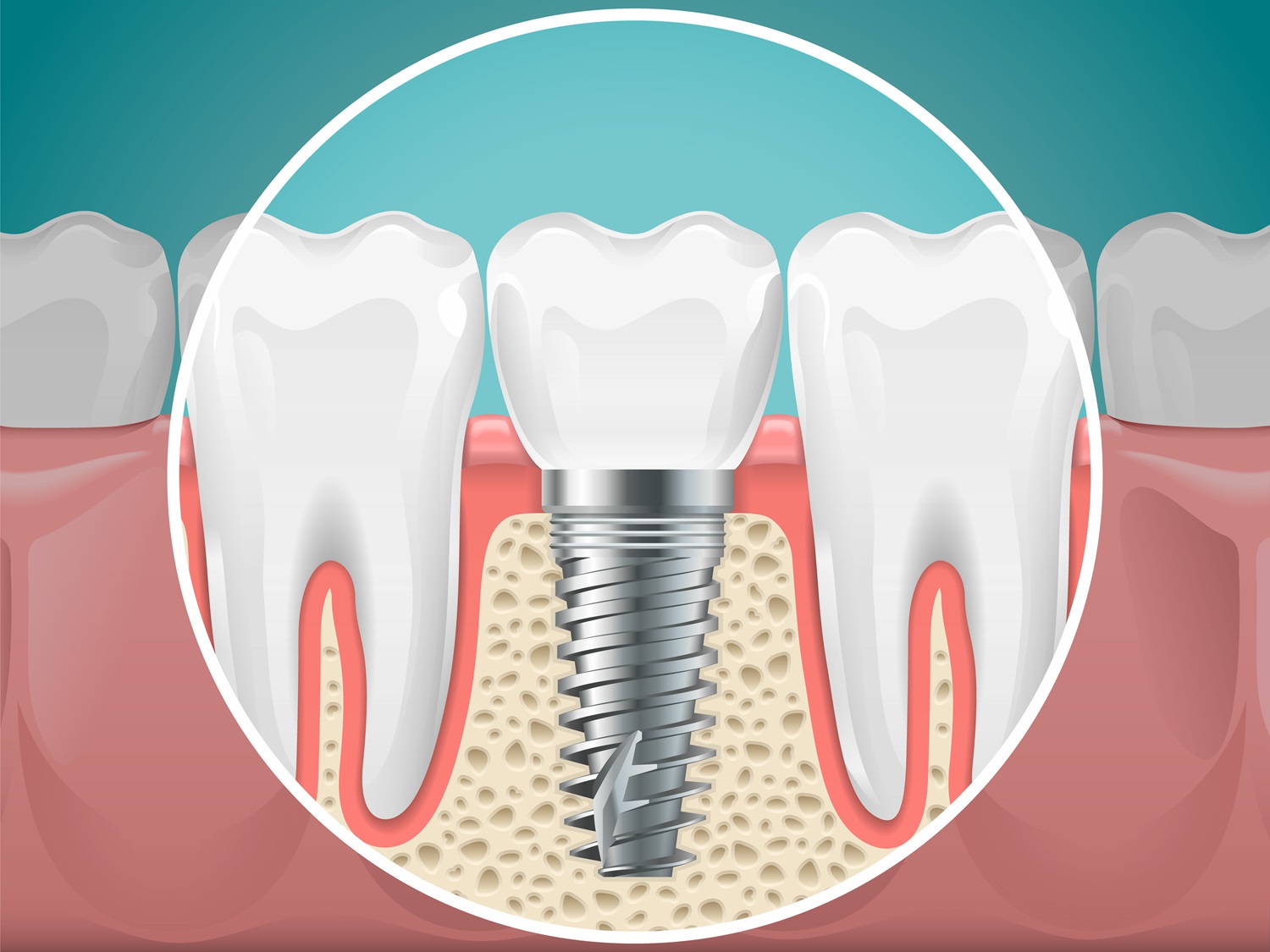 Can You Get Dental Implants on Finance? How to Spread the Cost in 2026