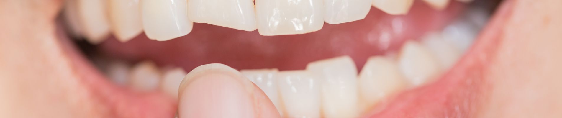 What Is a Dental Abscess – Symptoms, Causes & Treatment Guide