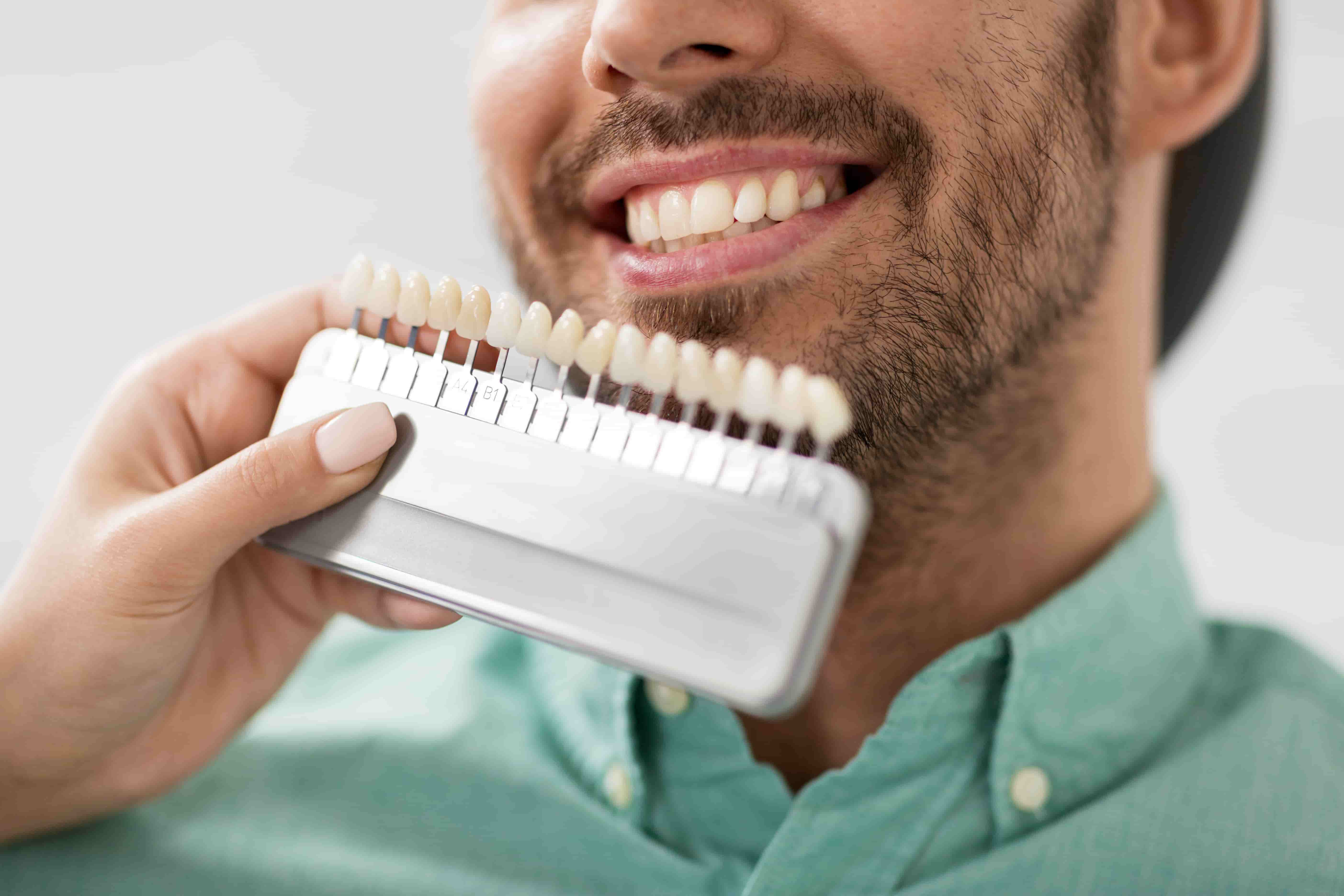 Natural-Looking Veneers vs the "Piano Key" Smile: What to Expect