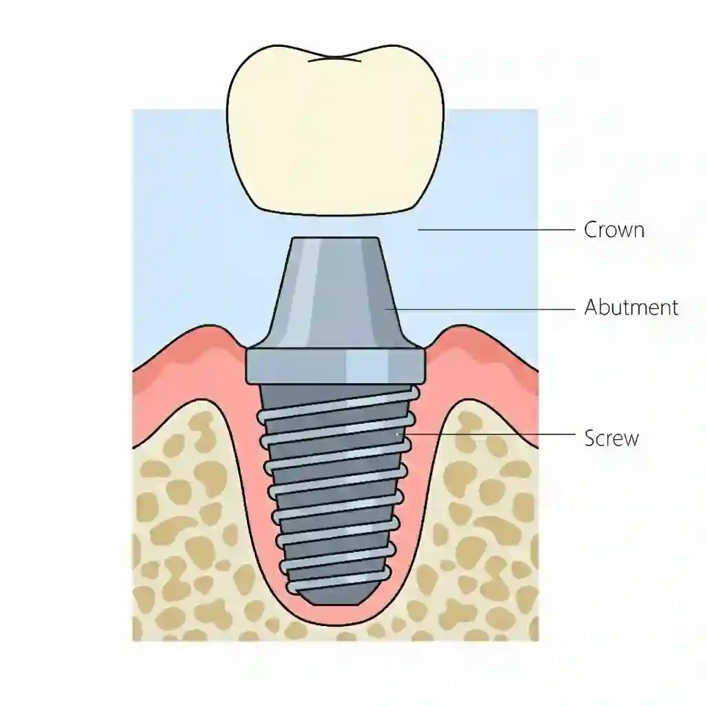 Anatomy of a dental implant showing the crown, abutment, and titanium implant post