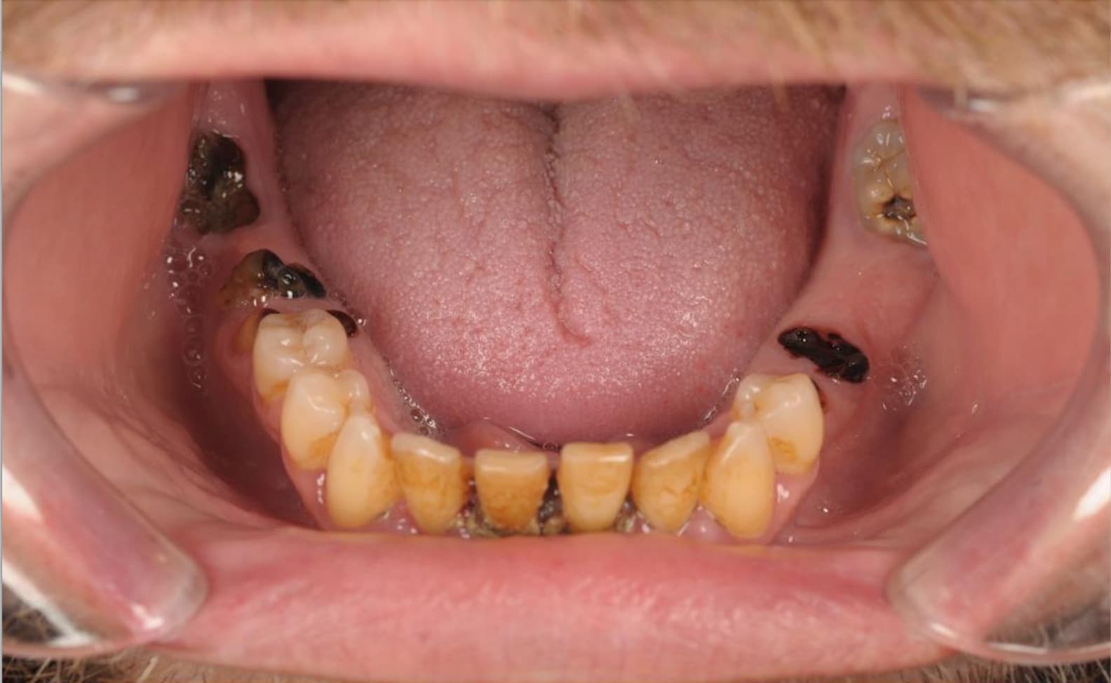 Before Full Mouth Rehabilitation