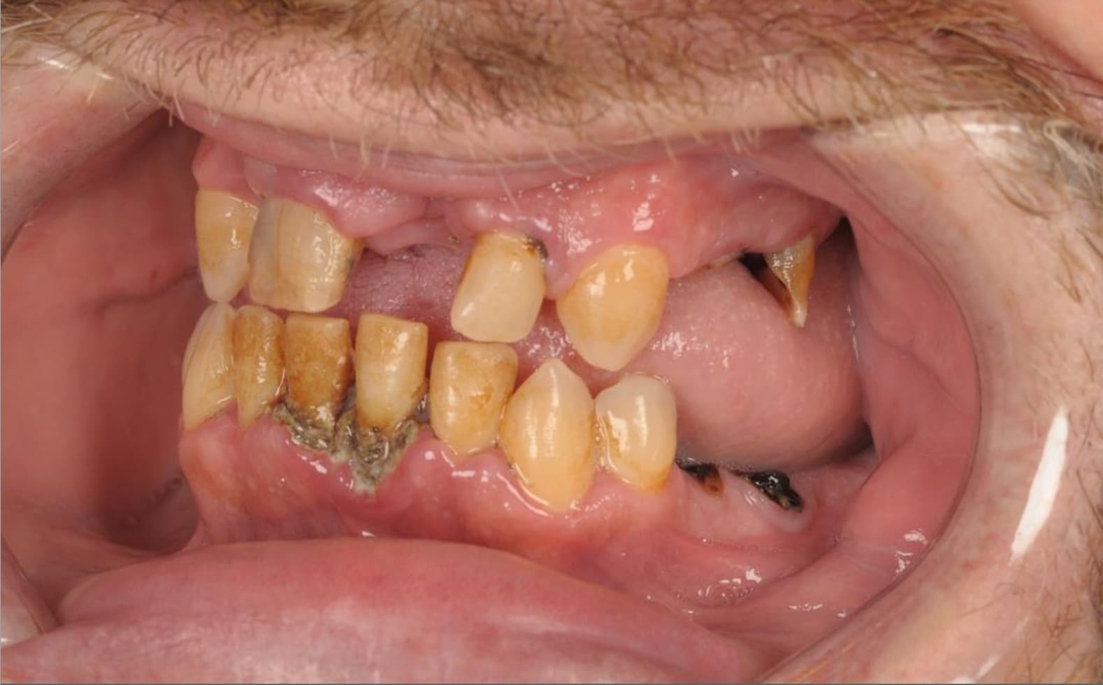 Before Full Mouth Rehabilitation