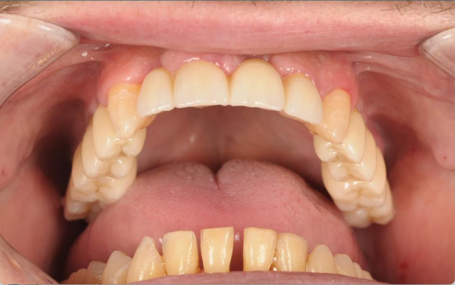 After Full Mouth Rehabilitation