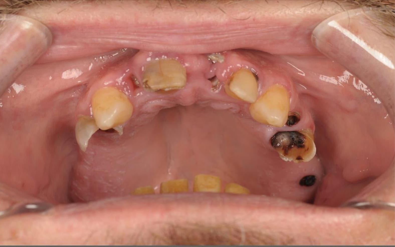 Before Full Mouth Rehabilitation