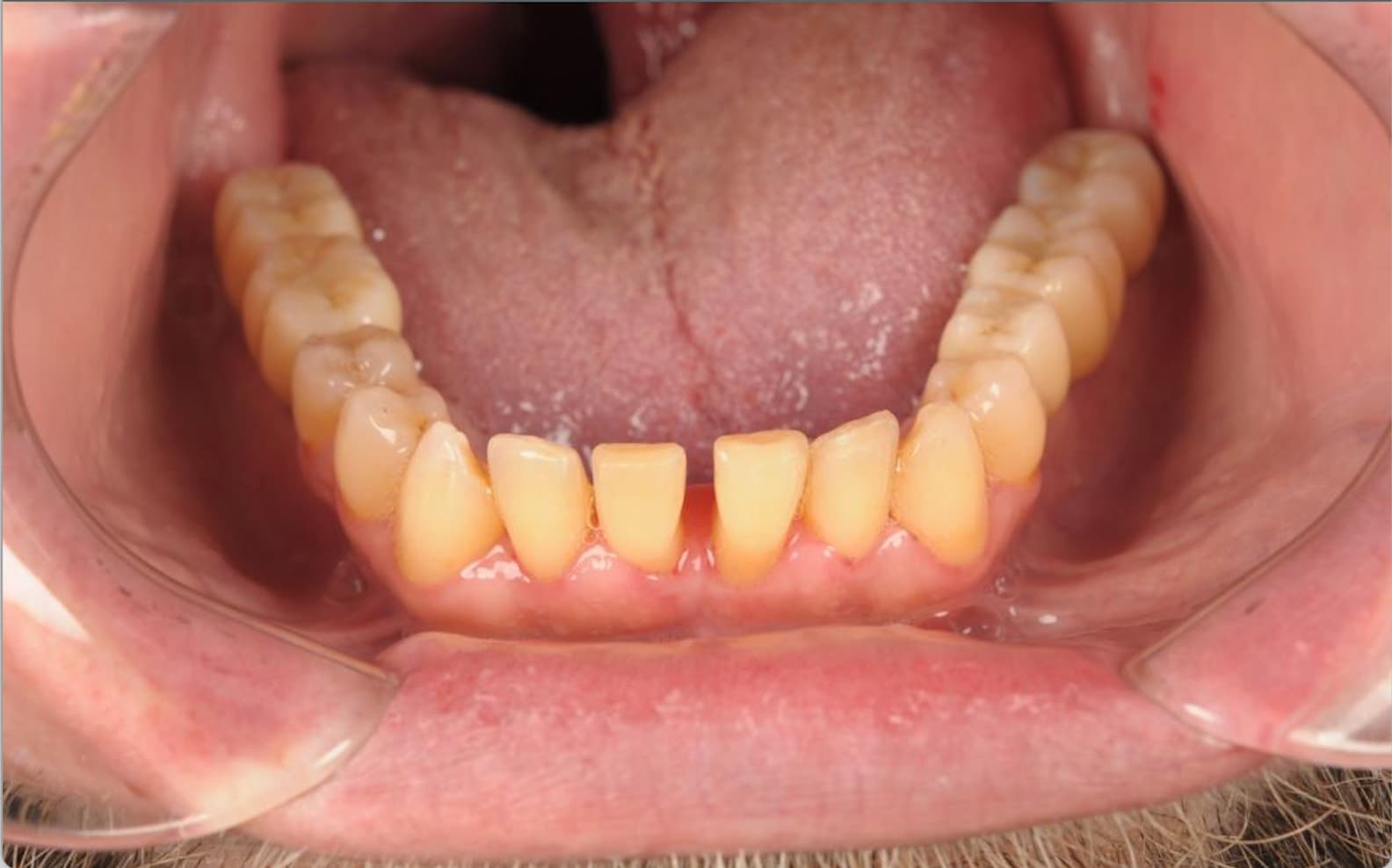 After Full Mouth Rehabilitation