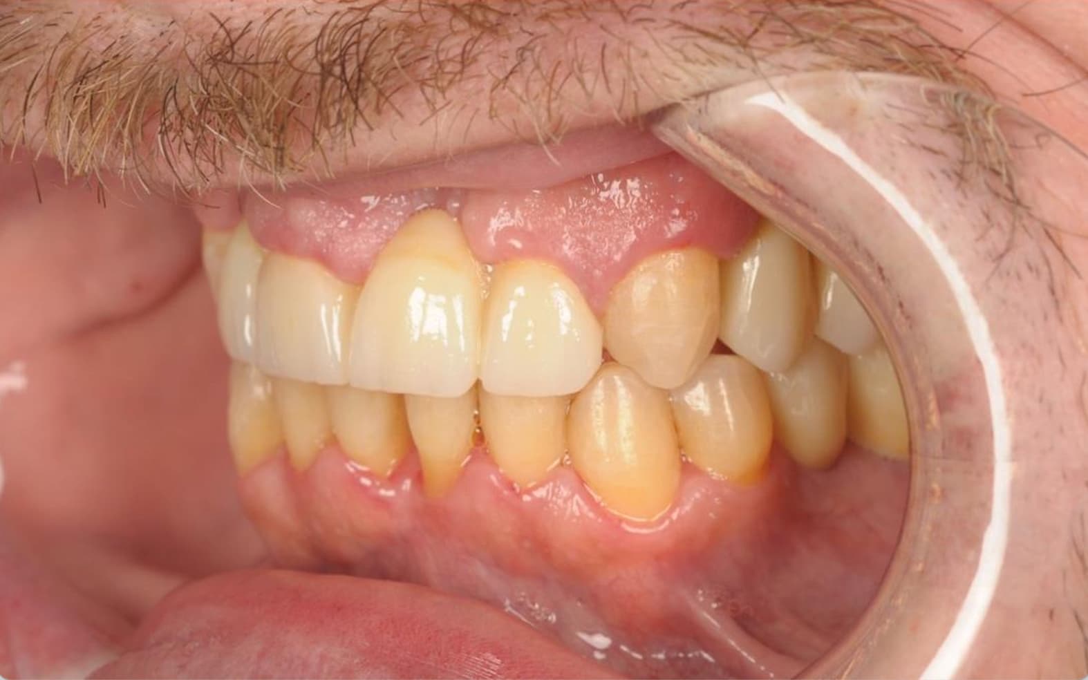 After Full Mouth Rehabilitation