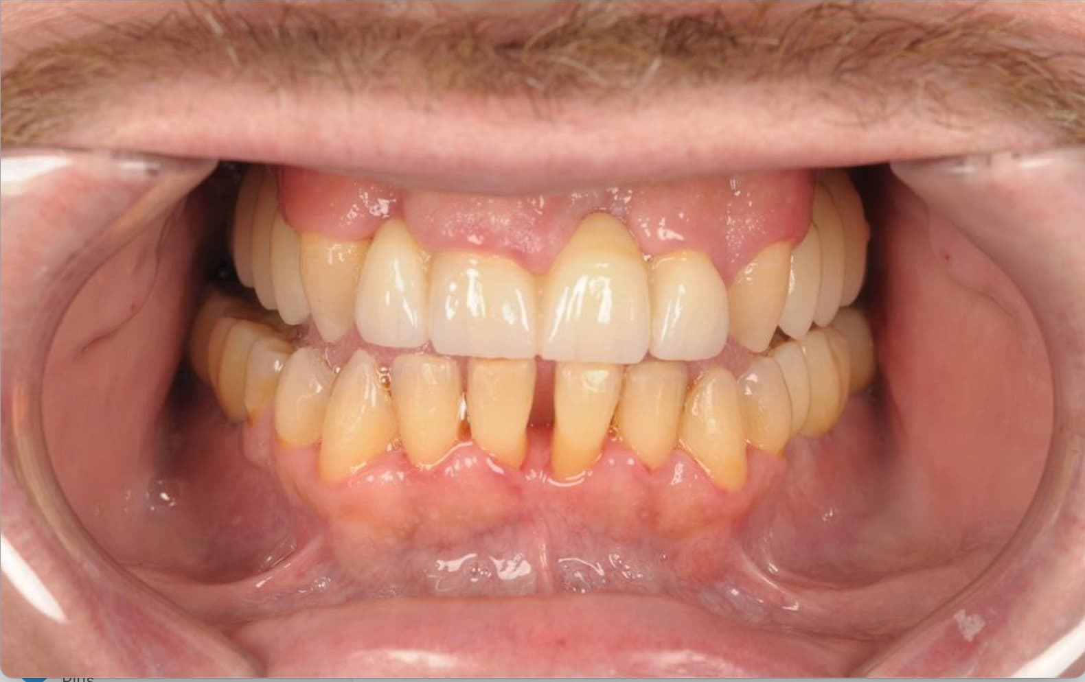 After Full Mouth Rehabilitation