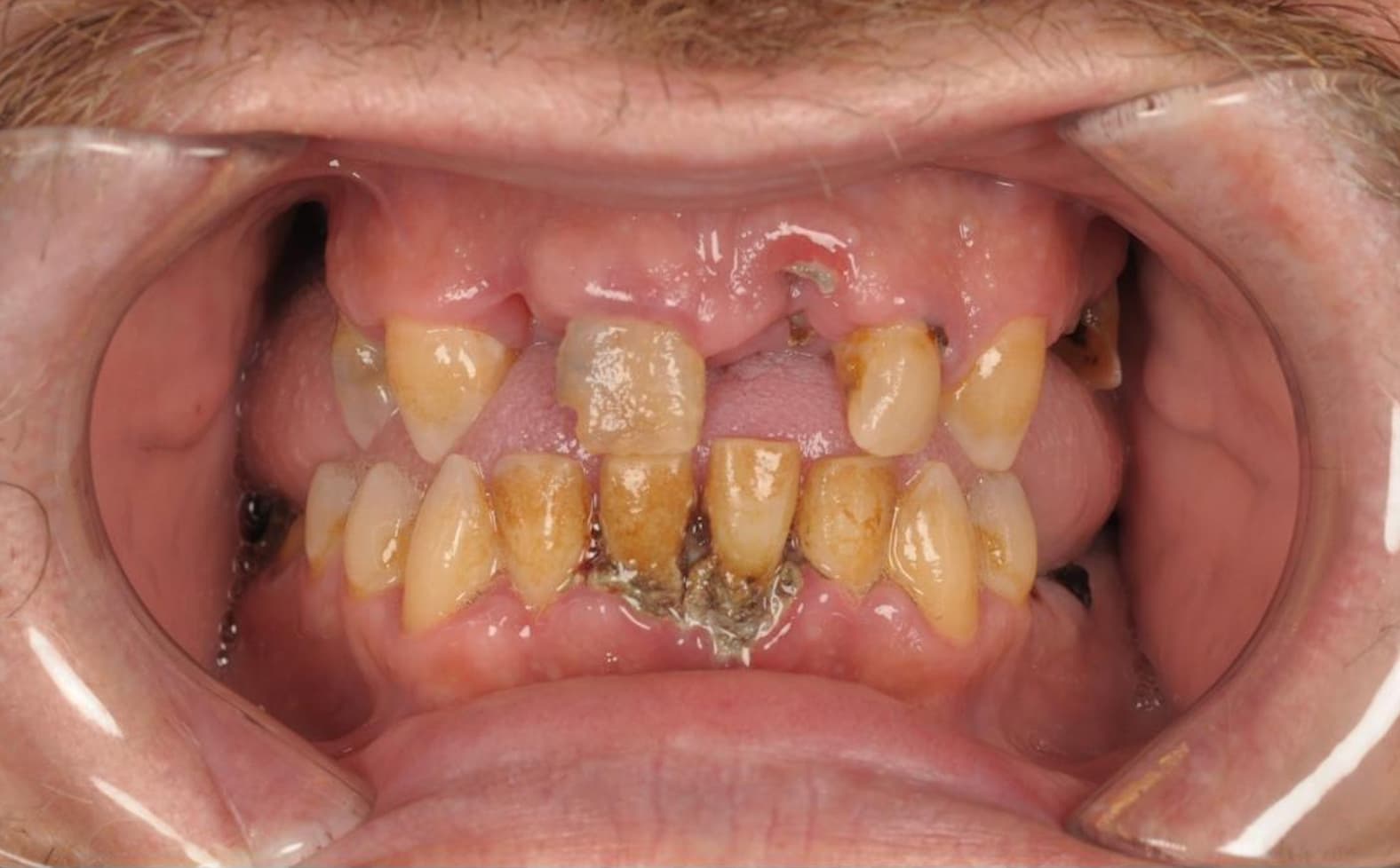 Before Full Mouth Rehabilitation