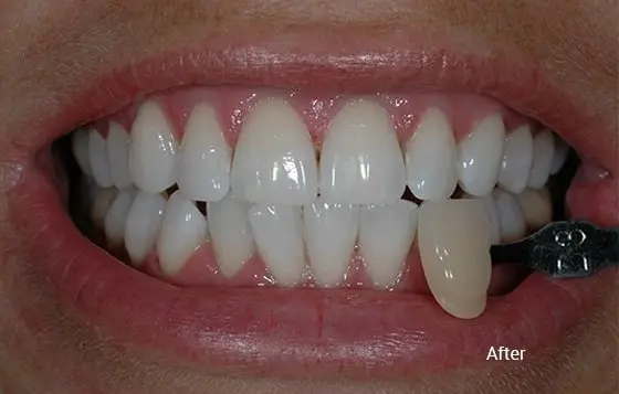 Teeth Whitening after