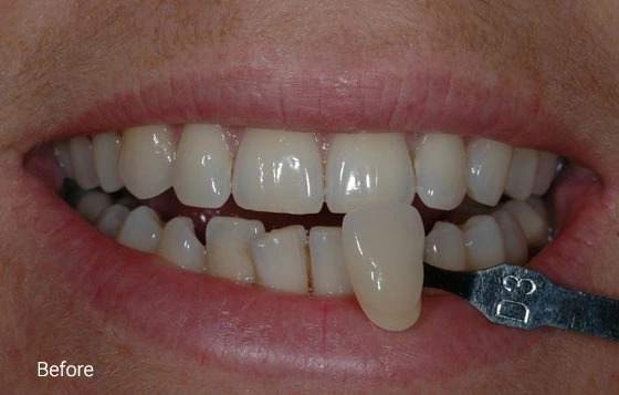 Teeth Whitening before