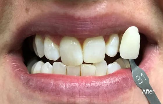 after teeth whitening 2