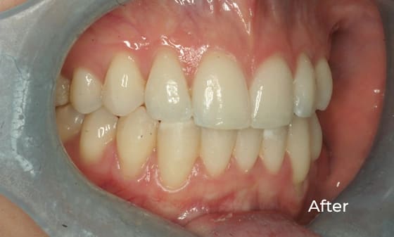 Invisalign After 18