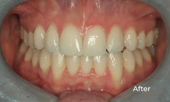 Invisalign After 19
