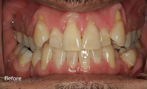 gap teeth before invisalign
