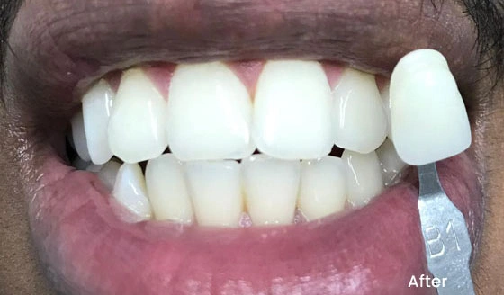 Teeth Whitening after 1