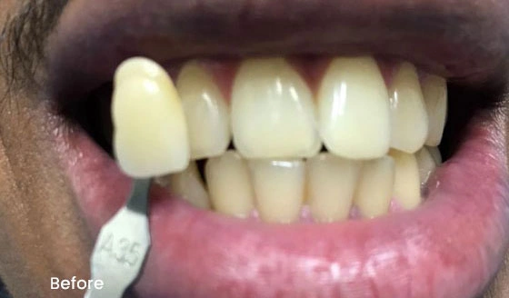 Teeth Whitening before 1