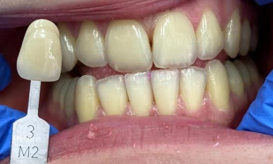 before teeth whitening 3