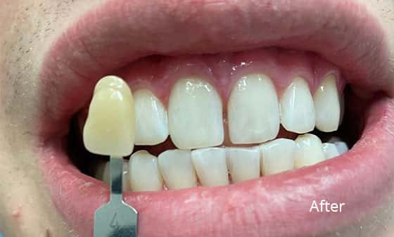 porcelain veneers after 3