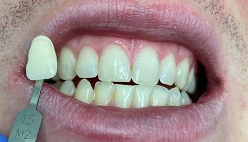 Porcelain Veneers before 1