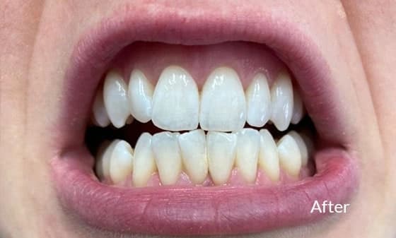 Invisalign and Bonding After 1 - London Teeth Whitening