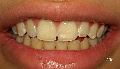 white spot treatment. ICON therapy after