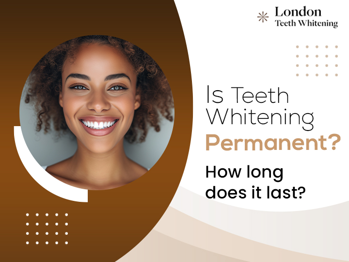 Is Teeth Whitening Permanent? How long does it last?
