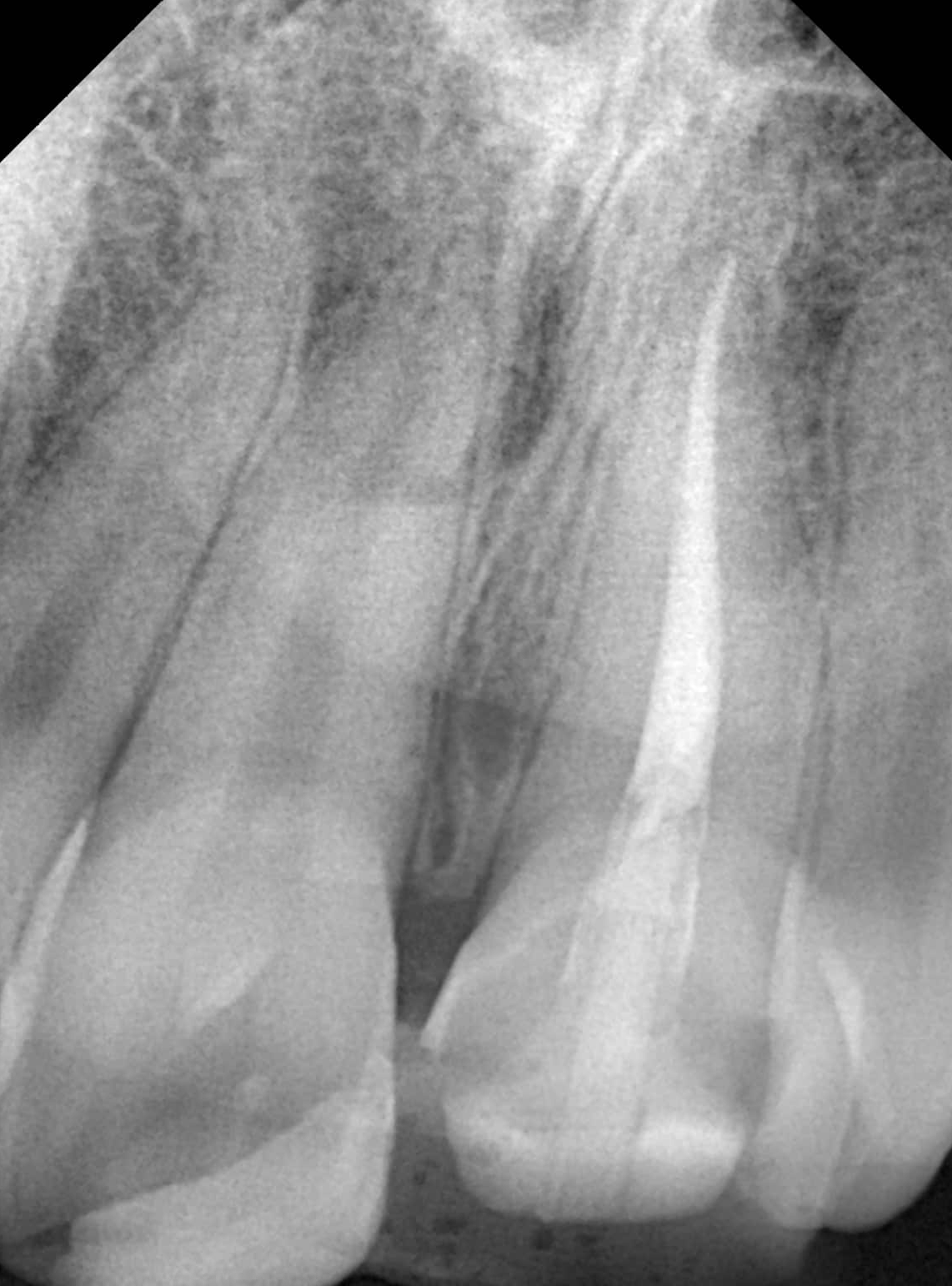 X-ray after root canal and crown