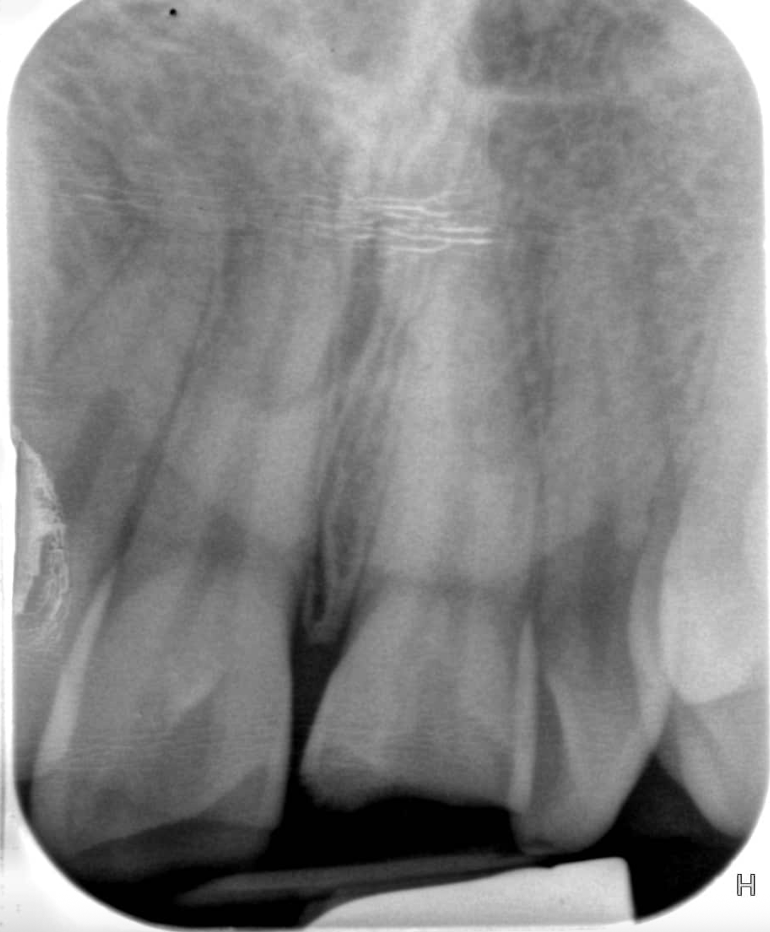 X-ray before treatment