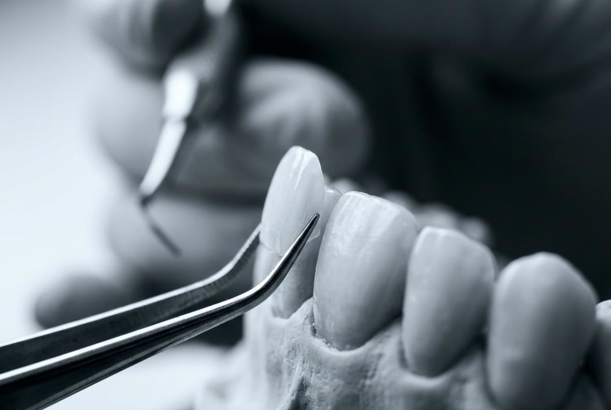 Faccetta sottile applicata su dente naturale con strumento di precisione