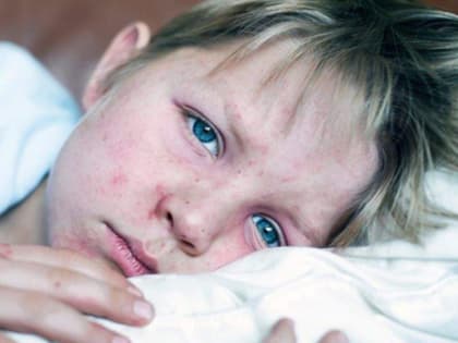 О профилактике кори