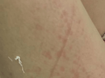 Владимирские врачи обнаружили у маленькой пациентки редкое заболевание