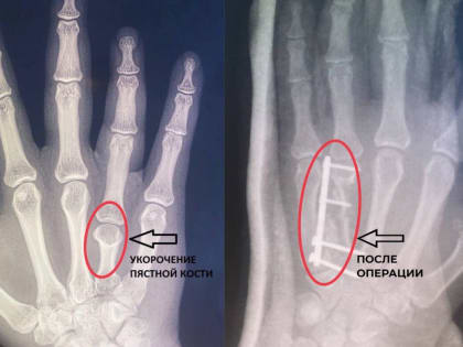 Во Владимире врачи удлинили девушке безымянный палец