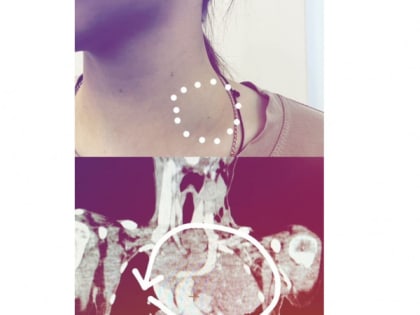 Во Владимире девочке-подростку поставили редкий диагноз