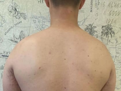 Успех генной терапии: как ребенок победил тяжелую форму псориаза