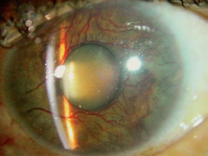 Ученые-медики ищут новые методы лечения глаукомы
